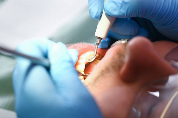 Best Emergency Root Canal Treatment in Peotone, IL
